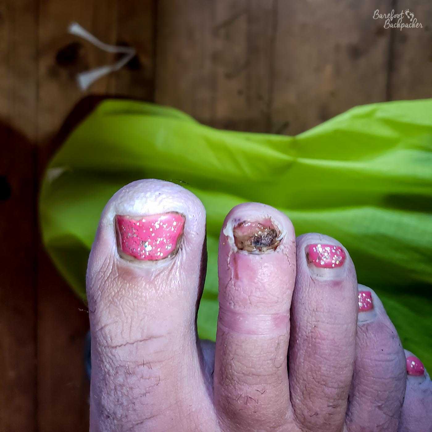 A close-up of the toes on someone's right foot. They are quite wrinkled because they have been hiking in the rain, even with socks and walking shoes on. Four of the toes have sparkly pink nail varnish. The toe nearest the big toe however has a black and red gelatinous vibe to it. There is no toenail, only a wound.